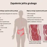 Ilustracja przedstawia schemat ludzkiego układu pokarmowego z zaznaczonymi objawami zapalenia jelita grubego.