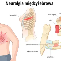 Ilustracja przedstawia mężczyznę z bólem w klatce piersiowej i schematyczne przekroje żeber z nerwami.