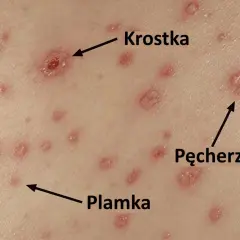 Zbliżenie na skórę z krostkami, pęcherzykami i plamkami, charakterystycznymi dla ospy wietrznej.
