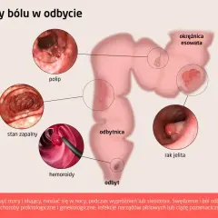 Ilustracja przedstawia schemat jelita grubego z zaznaczonymi zmianami: polip, stan zapalny, hemoroidy, rak jelita.