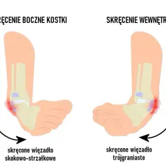 Ile leczy się skręcenie kostki? Poznaj skuteczne metody rehabilitacji