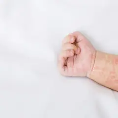 Rączka dziecka z wysypką na białym tle.