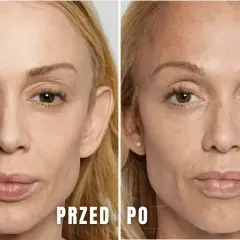 Porównanie twarzy przed i po zabiegu stymulatorem tkankowym.