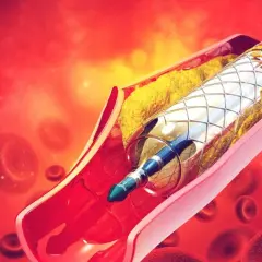 Stent w tętnicy z blaszką miażdżycową i krwinkami czerwonymi.