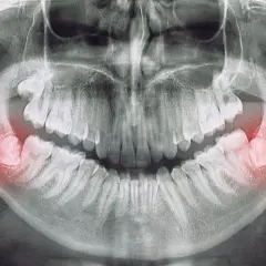 Gdzie z bólem zęba Chełm? Znajdź natychmiastową pomoc dentystyczną