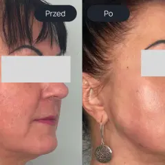 Porównanie twarzy przed i po zabiegu liftingu nićmi.