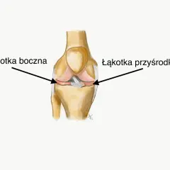 Ilustracja anatomiczna stawu kolanowego z zaznaczonymi łakotkami przyśrodkową i boczną.