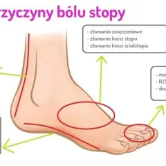Ból śródstopia przyczyna: poznaj najczęstsze źródła dyskomfortu