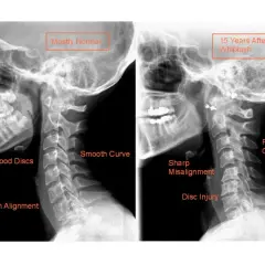 Skręcenie kręgosłupa szyjnego: niebagatelne objawy neurologiczne, które musisz znać