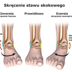 Skręcenie kostki objawy: Jak rozpoznać i unikać powikłań
