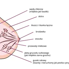 Schemat budowy piersi z zaznaczonymi elementami: skóra, brodawka, przewody mlekowe, płaty gruczołu sutkowego, węzły chłonne i guzek rakowy.