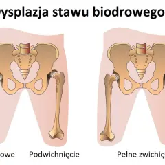 Ilustracja porównująca zdrowe biodro, podwichnięcie i pełne zwichnięcie biodra.