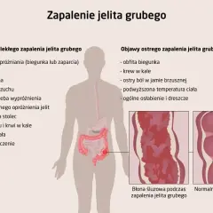 Ilustracja przedstawia schemat ludzkiego układu pokarmowego z zaznaczonymi objawami zapalenia jelita grubego.