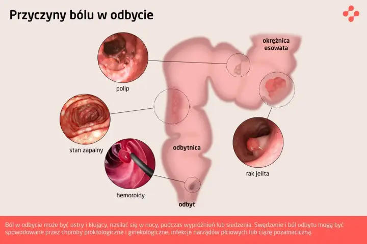 Ilustracja przedstawia schemat jelita grubego z zaznaczonymi zmianami: polip, stan zapalny, hemoroidy, rak jelita.