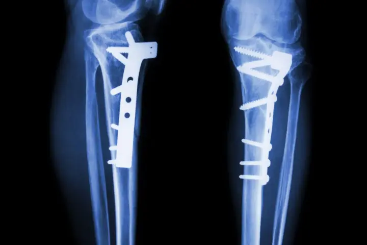 RTG kolan z implantami i śrubami po osteotomii.