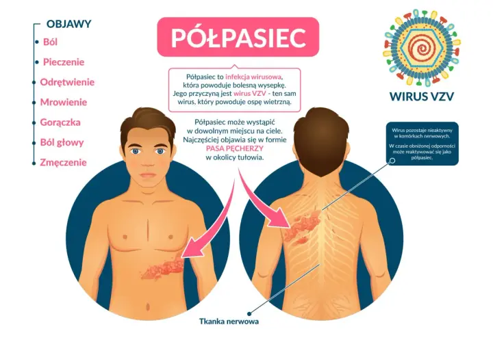 Ilustracja przedstawia objawy półpaśca na ciele człowieka, wirusa VZV i schemat tkanki nerwowej.