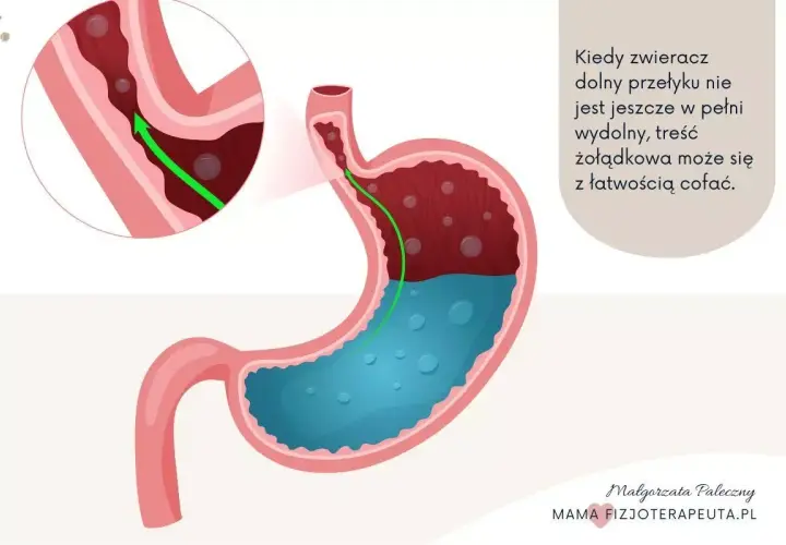 Ilustracja anatomiczna żołądka i przełyku z zaznaczonym refluksem.