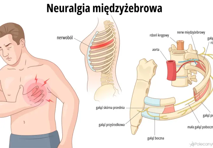 Ilustracja przedstawia mężczyznę z bólem w klatce piersiowej i schematyczne przekroje żeber z nerwami.