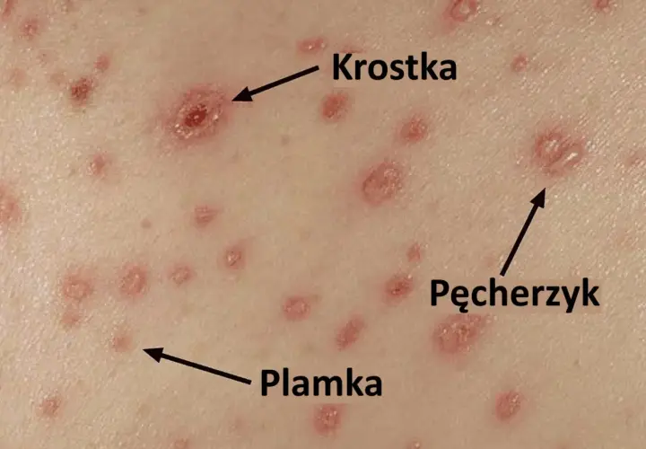 Zbliżenie na skórę z krostkami, pęcherzykami i plamkami, charakterystycznymi dla ospy wietrznej.