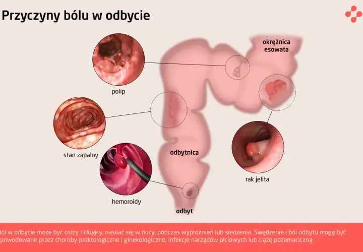 Ilustracja przedstawia schemat jelita grubego z zaznaczonymi zmianami: polip, stan zapalny, hemoroidy, rak jelita.