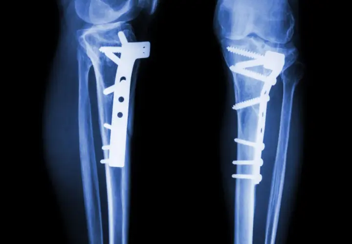 RTG kolan z implantami i śrubami po osteotomii.