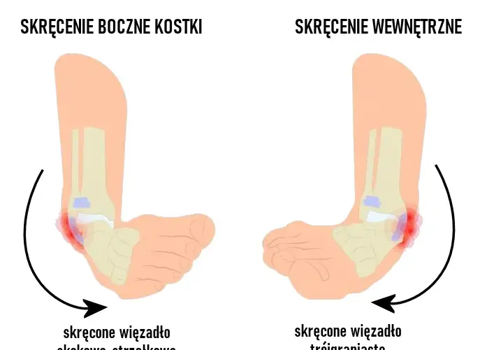 Ile leczy się skręcenie kostki? Poznaj skuteczne metody rehabilitacji