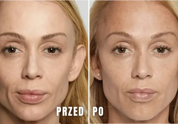 Porównanie twarzy przed i po zabiegu stymulatorem tkankowym.