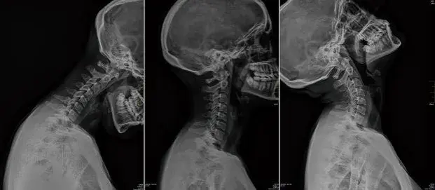 Skręcenie kręgosłupa szyjnego – ile zwolnienia i co warto wiedzieć