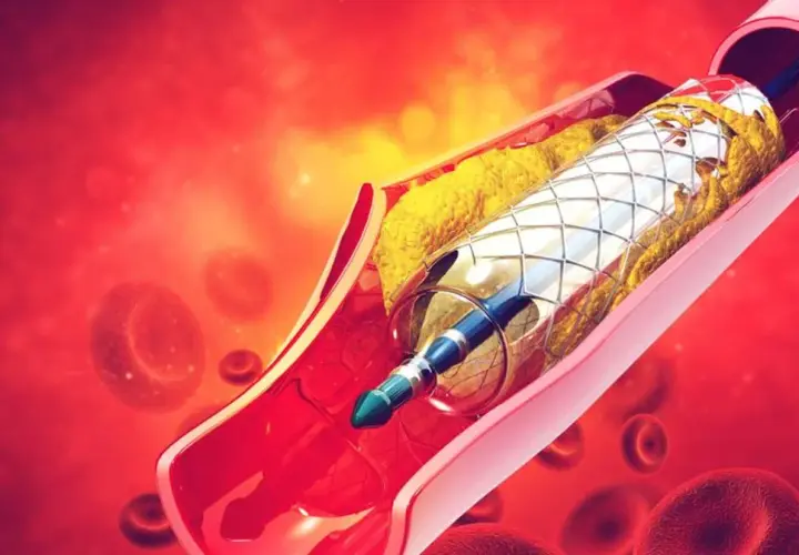 Stent w tętnicy z blaszką miażdżycową i krwinkami czerwonymi.