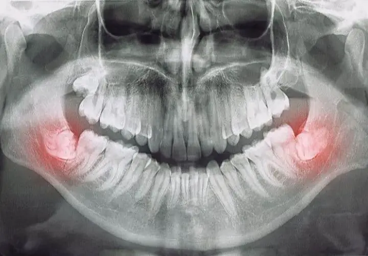 Gdzie z bólem zęba Chełm? Znajdź natychmiastową pomoc dentystyczną