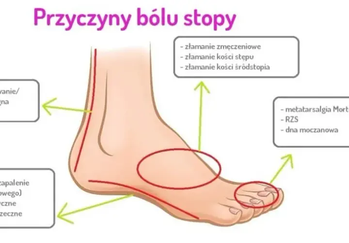 Ból śródstopia przyczyna: poznaj najczęstsze źródła dyskomfortu