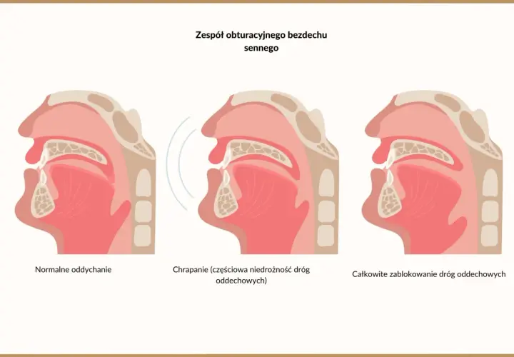 Ilustracja pokazuje przekrój dróg oddechowych. Od normalnego oddychania, przez częściową niedrożność powodującą chrapanie, aż do całkowitego zablokowania, które jest objawem bezdechu sennego.