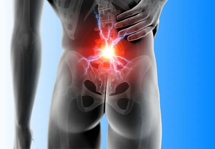 Anatomia bólu w dolnej części pleców i pośladku, z błyskawicami bólu.