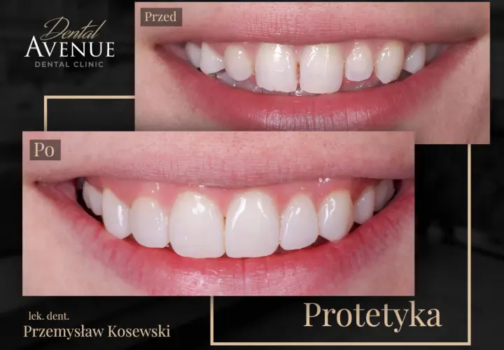 Porównanie uśmiechu przed i po zastosowaniu licówek.