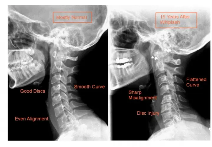 Skręcenie kręgosłupa szyjnego: niebagatelne objawy neurologiczne, które musisz znać