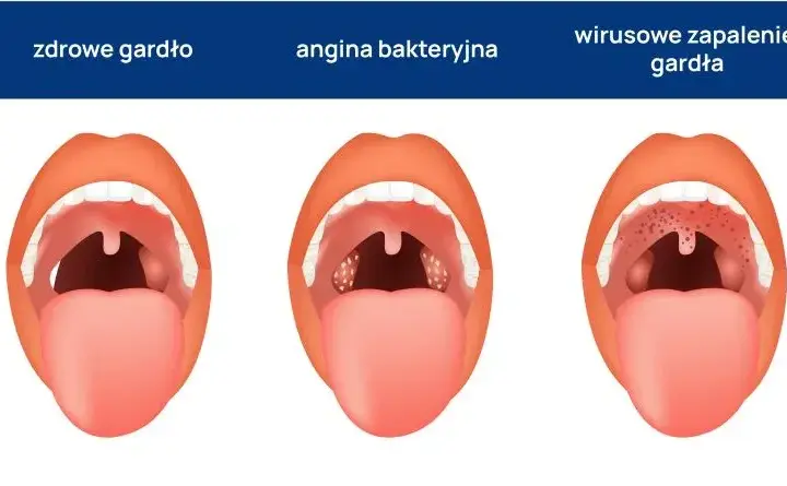 Jak złagodzić ból gardła przy anginie – skuteczne metody i porady