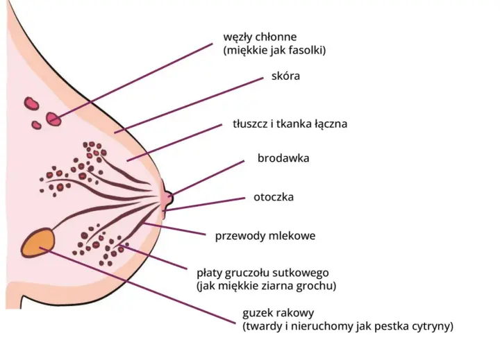 Schemat budowy piersi z zaznaczonymi elementami: skóra, brodawka, przewody mlekowe, płaty gruczołu sutkowego, węzły chłonne i guzek rakowy.