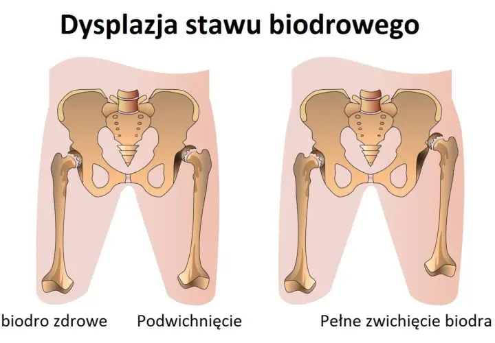 Ilustracja porównująca zdrowe biodro, podwichnięcie i pełne zwichnięcie biodra.