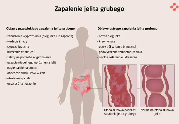 Ilustracja przedstawia schemat ludzkiego układu pokarmowego z zaznaczonymi objawami zapalenia jelita grubego.