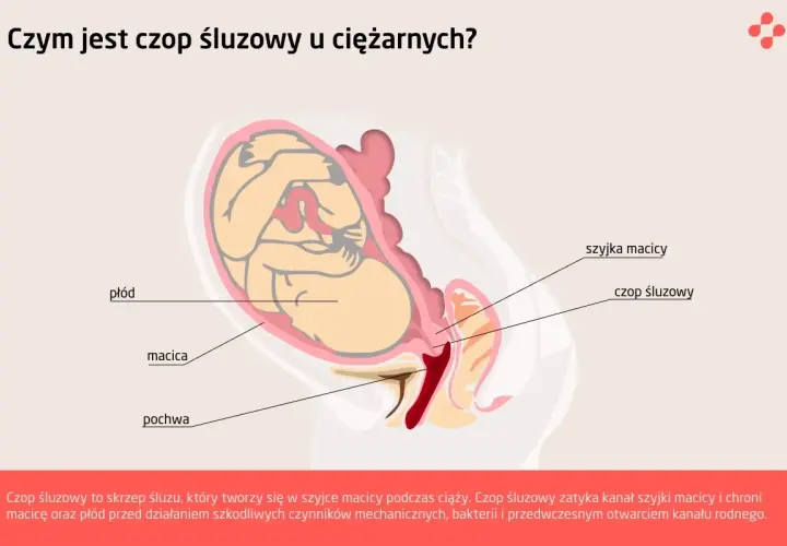 Ilustracja anatomiczna przedstawiająca płód w macicy, szyjkę macicy i czop śluzowy.