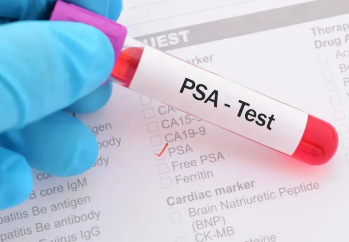 Probówka z krwią do badania PSA na tle formularza medycznego z zaznaczoną opcją PSA.