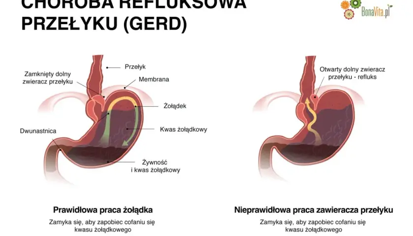 Ilustracja porównująca prawidłową i nieprawidłową pracę zwieracza przełyku, pokazująca refluks żołądkowy.