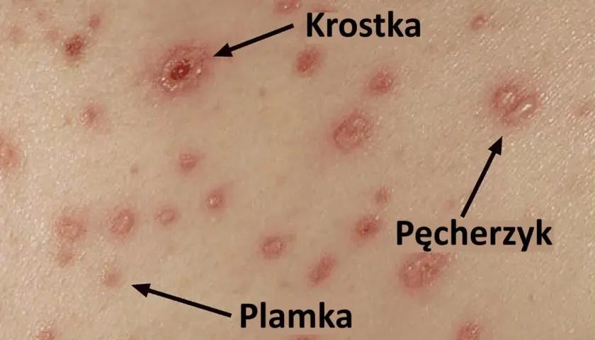 Zbliżenie na skórę z krostkami, pęcherzykami i plamkami, charakterystycznymi dla ospy wietrznej.