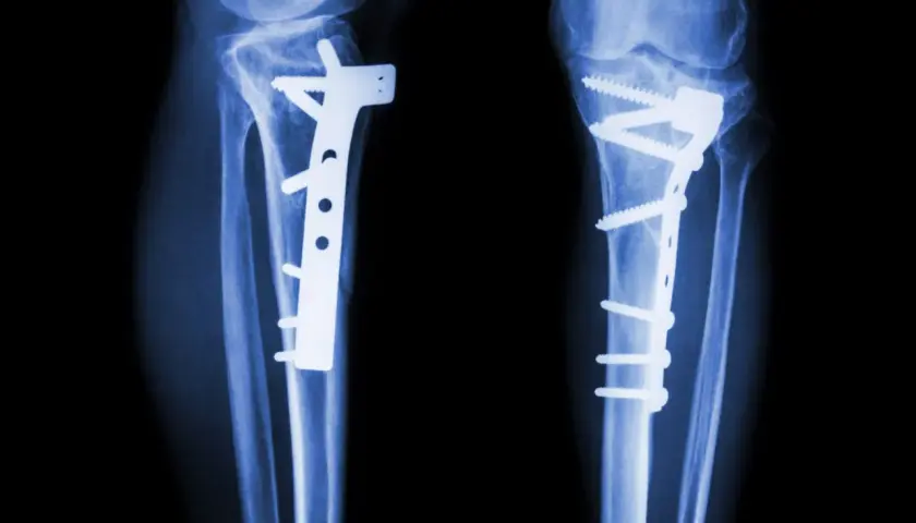 RTG kolan z implantami i śrubami po osteotomii.
