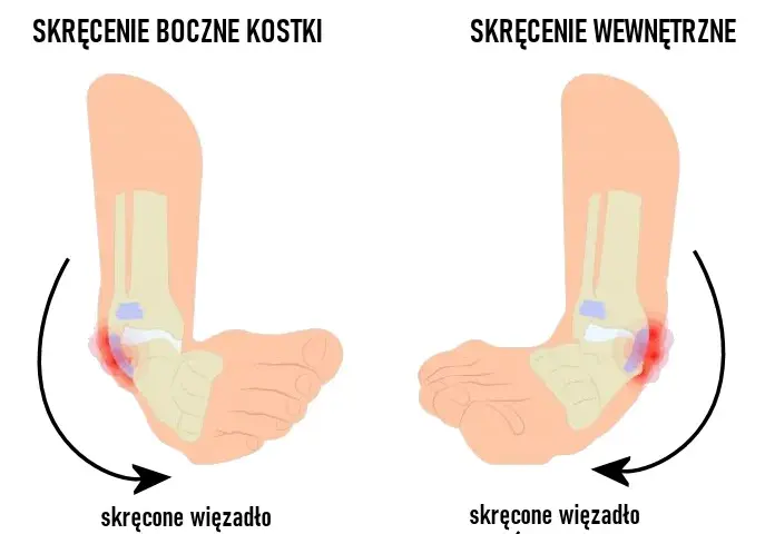 Ile leczy się skręcenie kostki? Poznaj skuteczne metody rehabilitacji