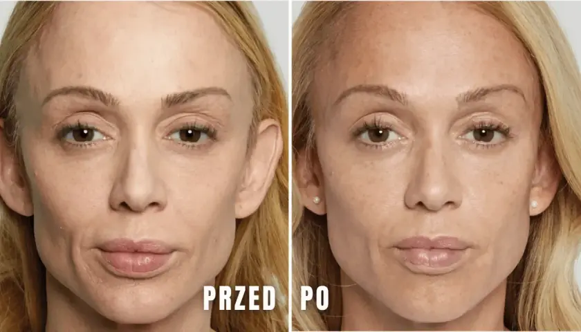 Porównanie twarzy przed i po zabiegu stymulatorem tkankowym.