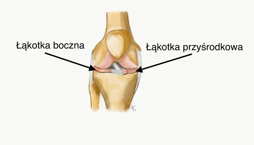 Ilustracja anatomiczna stawu kolanowego z zaznaczonymi łakotkami przyśrodkową i boczną.