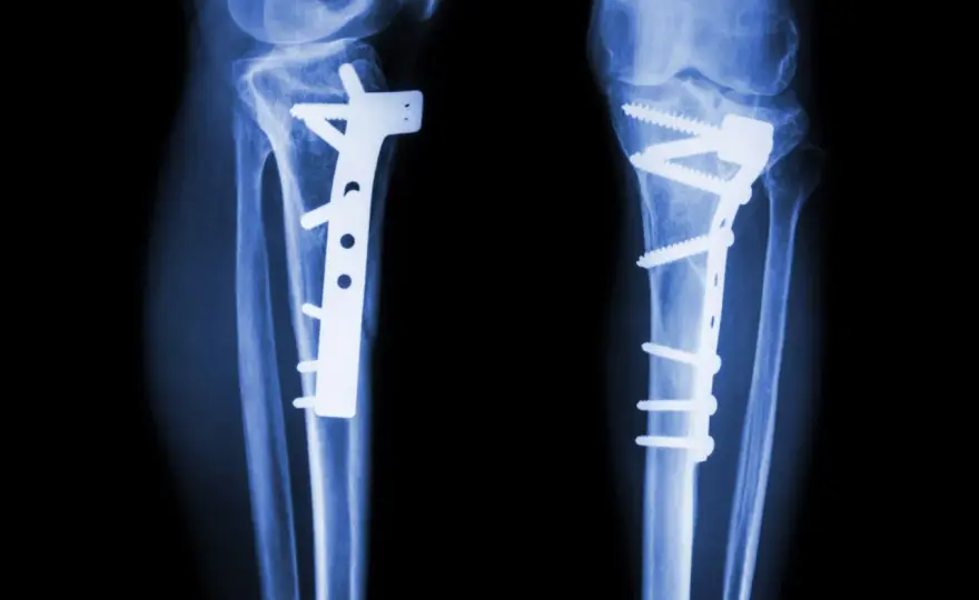 Osteotomia - czy to rozwiązanie dla Ciebie? Pełny przewodnik