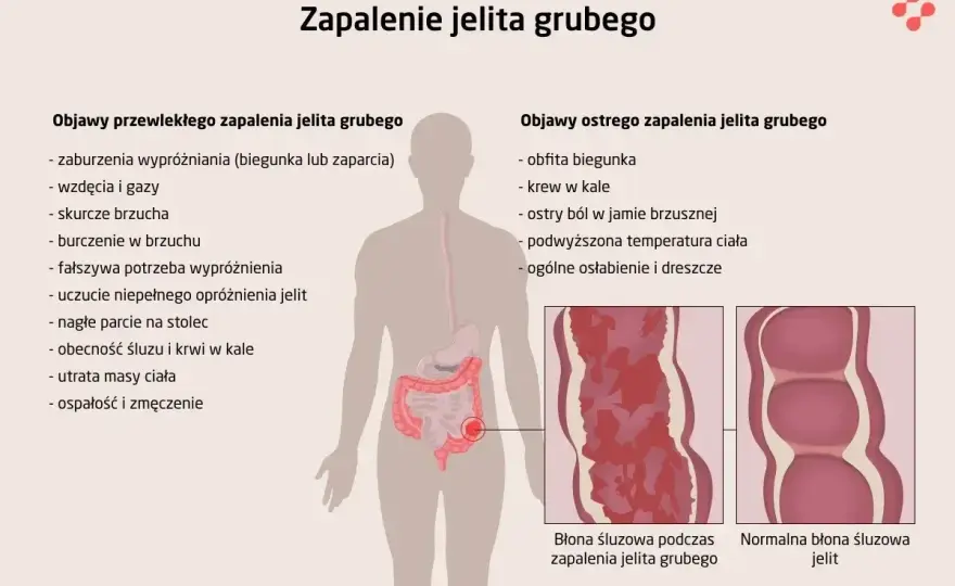 Zagazowane jelita - Objawy, przyczyny i kiedy szukać pomocy?