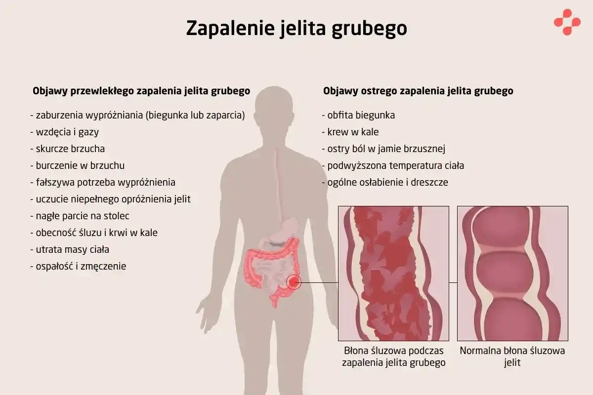 Zagazowane jelita - Objawy, przyczyny i kiedy szukać pomocy?